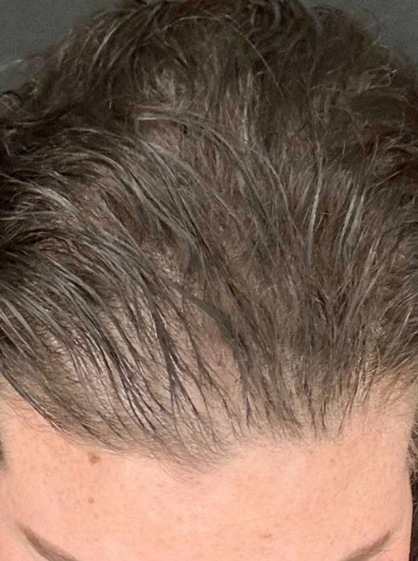 Antes